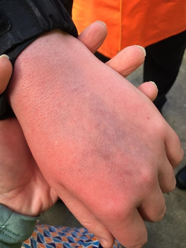 دست کبود شده با ضربه رونالدو