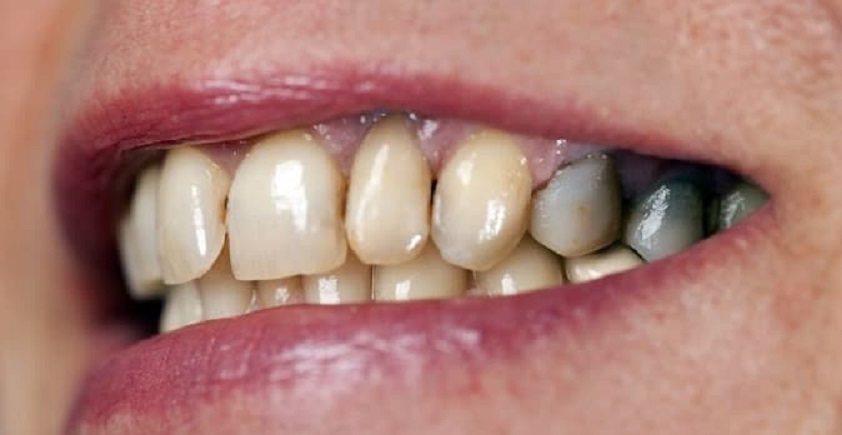 علت خراب شدن زود دندان های عقب/ آسیب نوشابه رژیمی به مینای دهان